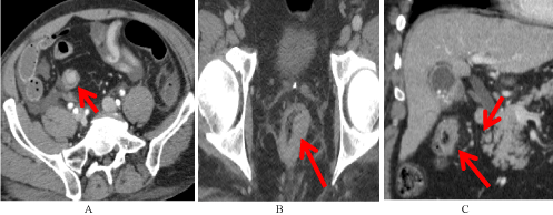 rectal cancer on ct scan