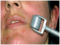 Steroid injection for cystic acne