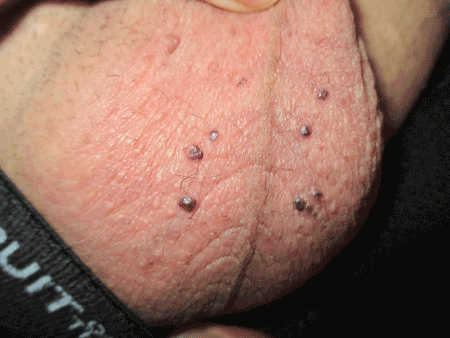Have small red dots on my penis