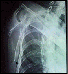 Solitary osteochondroma of the Scapula: an uncommon localization