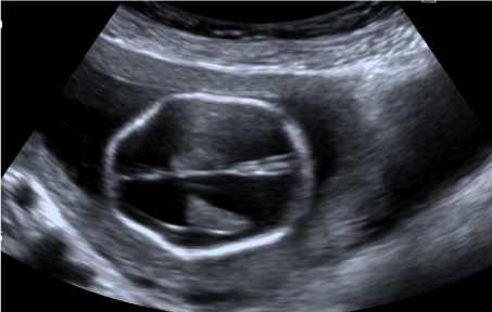 Fetal ultrasound of type 2 and 3 Chiari malformation