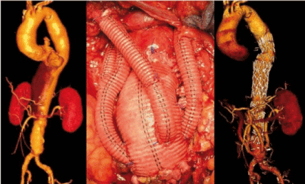 Surgical Treatment Of Thoracic Abdominal Aortic Aneurysms