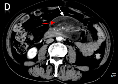 A Case Report Of Mesenteric Panniculitis A Case Report Of Mesenteric Panniculitis