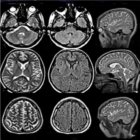 Posterior reversible encephalopathy syndrome:What happens if untreated?