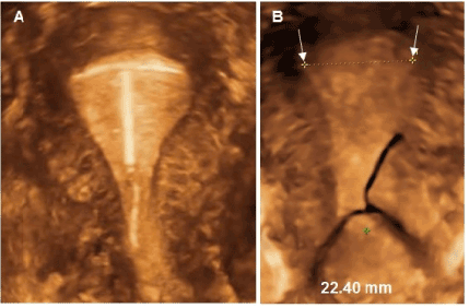 Malposition and displacement of intrauterine devices–diagnosis
