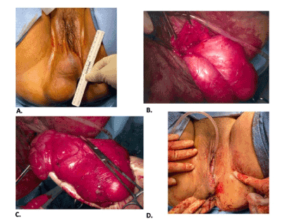 Angiomyofibroblastoma: A rare benign gynecologic tumor mistaken