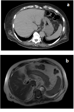 lung parenchyma mesothelioma