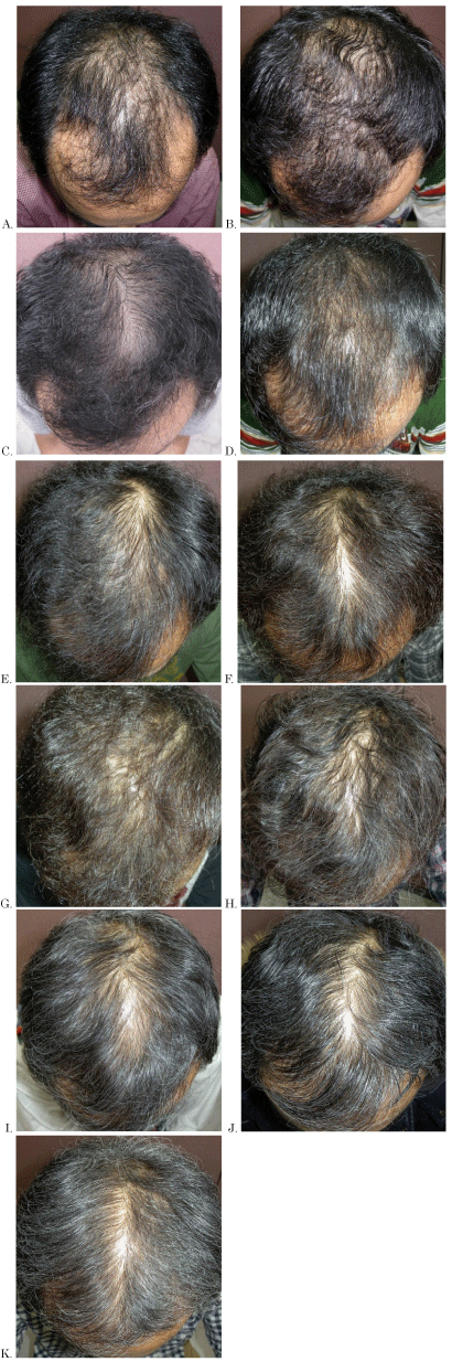 Long-term (10-year) efficacy of finasteride in 523 Japanese men with  androgenetic alopecia
