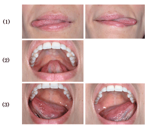 Influence Of Tongue Movements On Masticatory Efficiency