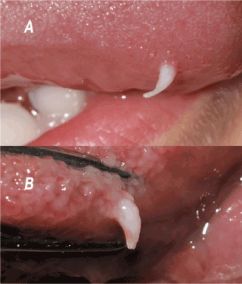 white papilloma on tongue)