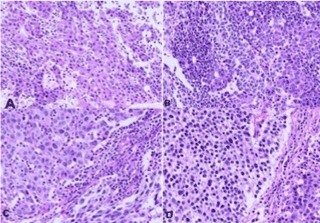 Neuroendocrine cancer prognosis liver Metastatic cancer in liver treatment