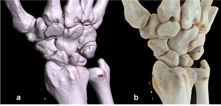 scaphoid fracture ct scan)