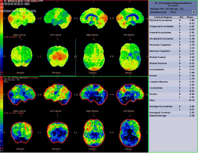 F-18 PET/CT alzheimer like primary progressive aphasia