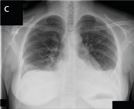 Extracorporeal membrane oxygenation for severe transfusion-related ...