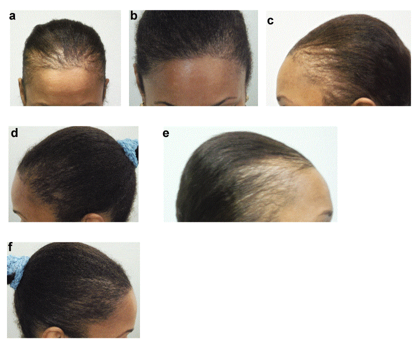 African American Hair Loss What Can Be Done