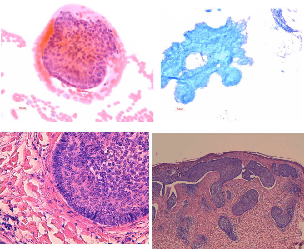 Cytology As A Diagnosis Test For Basal Cell Carcinoma