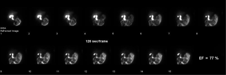 Assessment alternate parameters in sincalide cholescintigraphy and possible role patient selection in gall bladder A case-control study