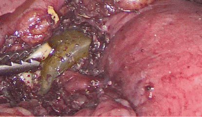 Presenter Mathis hund Isolated gastric band tube erosion – Unusual complication of gastric band