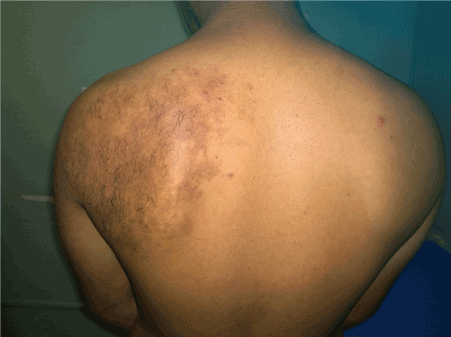 Acquired melanosis with hypertrichosis and intralesional acne in a 21-year  old male patient: A treatment strategy