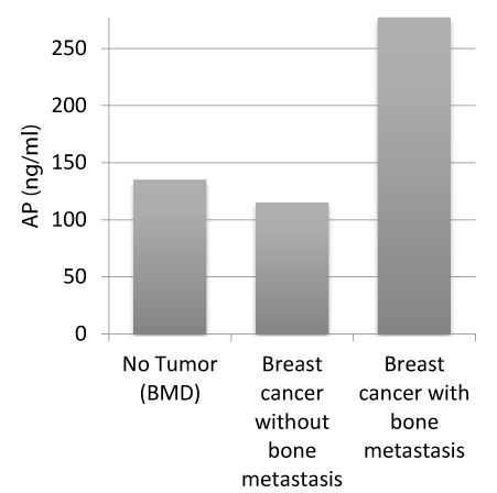 Prognostic Value Of Bone Marker Beta Crosslaps In Patients With Breast Carcinoma