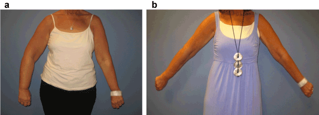 Feasibility of liposuction for treatment of arm lymphedema from breast  cancer: A prospective study and review of the literature