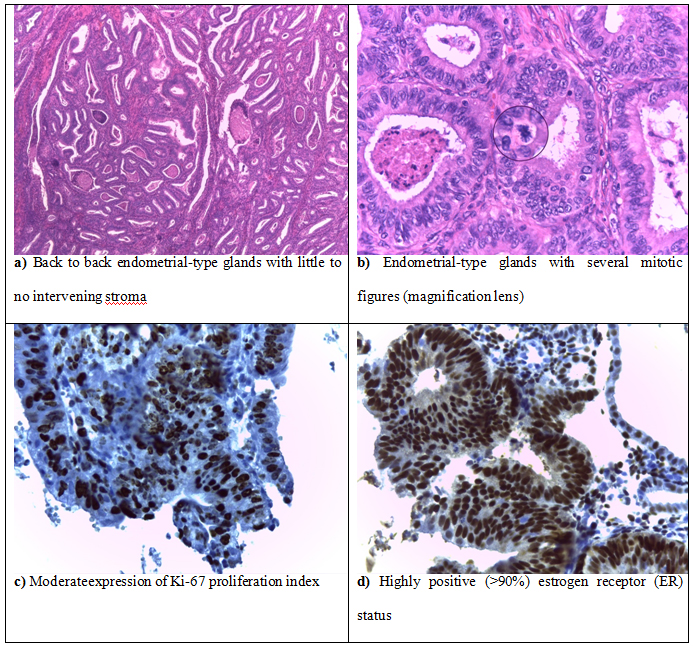 Endometrial cancer histology, GHID 04/12/ - Portal Legislativ - Uterine cancer histology