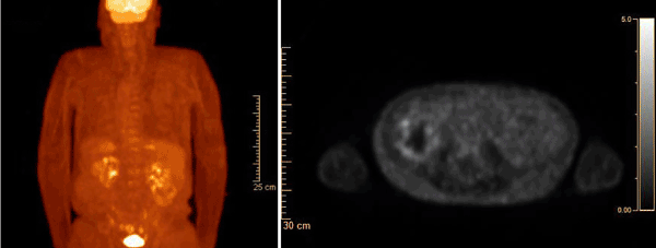 ultrasound images of kidney tumors