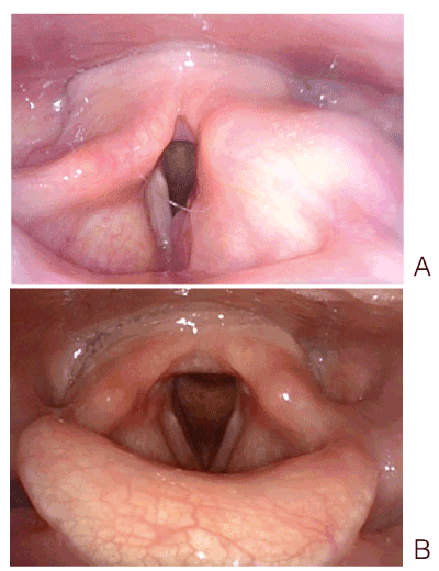 treatment for inverting papilloma