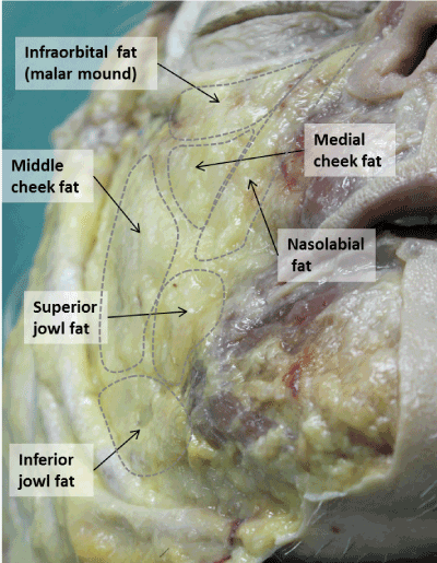 Anatomy And Aging Of Cheek Fat Compartments