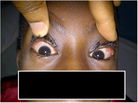 conjunctival papilloma excision
