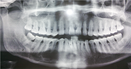 botryoid odontogenic cyst