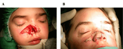 Ablative Dog Bites Involving The Childish Nose