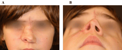 Ablative Dog Bites Involving The Childish Nose