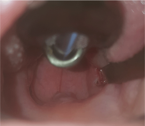 Tonsil Tongue Out Porn - Effect of modified bipolar tonsillectomy on postoperative pain