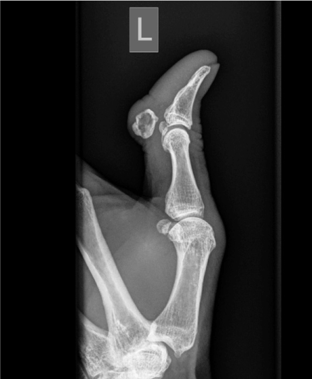 Osteochondroma occurring in a sesmoid bone of the thumb