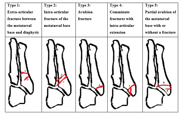 How Are Fifth Metatarsal Fractures Managed By The Virtual Fracture ...