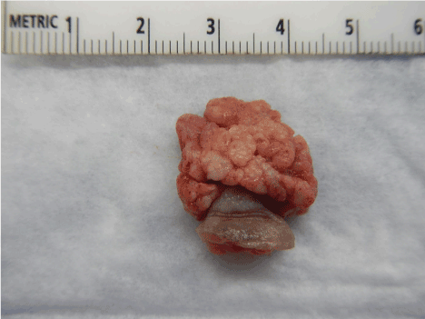 squamous papilloma gross
