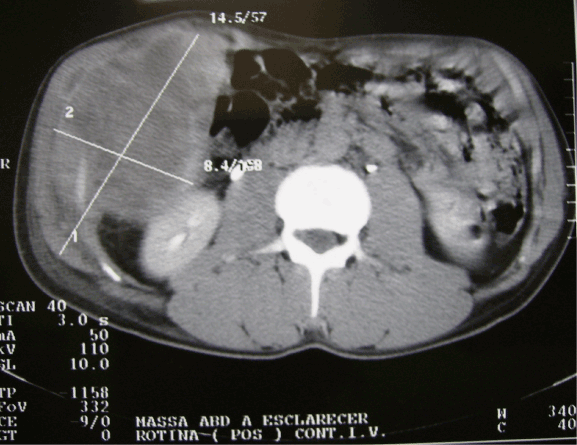 Cancer sarcoma in abdomen. Cancer sarcoma in abdomen