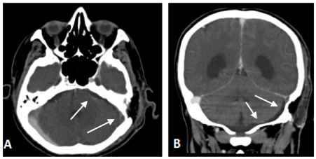 Septic Thrombophlebitis Of The Sigmoid Sinus After Vestibular Schwannoma Resection A Case Report And Literature Review Septic Thrombophlebitis Of The Sigmoid Sinus After Vestibular Schwannoma Resection A Case Report And Literature Review