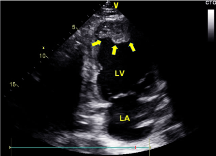 A 36-year-old man with concomitant left ventricular apical thrombus and bilateral acute lower ...