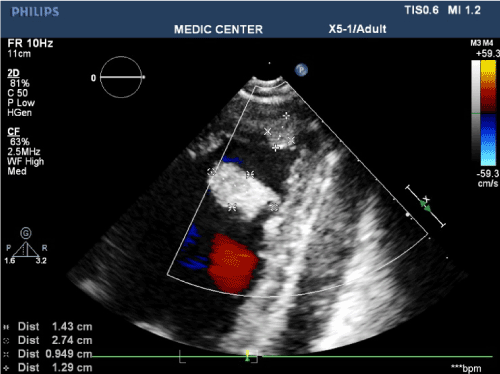 LV myxoma on Real-time 3DTTE in a young patient with dilated cardiomyopathy and apical thrombus