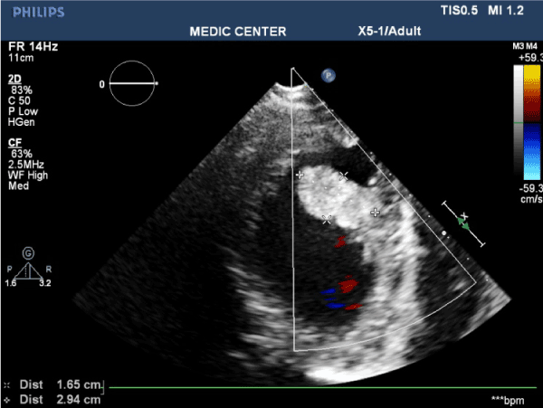 LV myxoma on Real-time 3DTTE in a young patient with dilated cardiomyopathy and apical thrombus