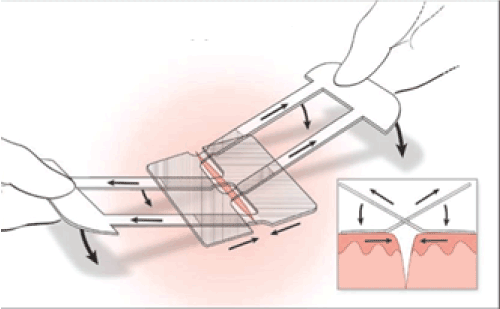 A New Form of Noninvasive Wound Closure With a Surgical Zipper